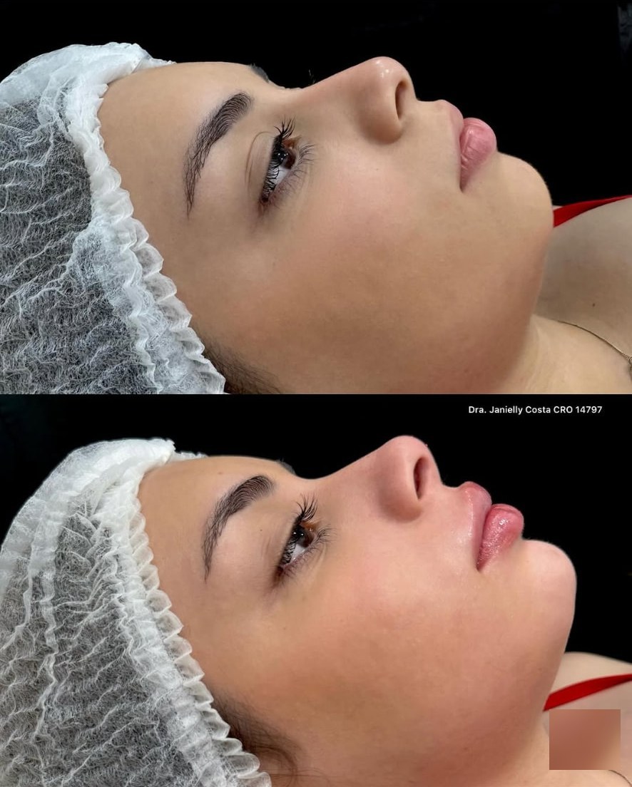 Antes e depois de harmonização facial — perfil mais harmônico