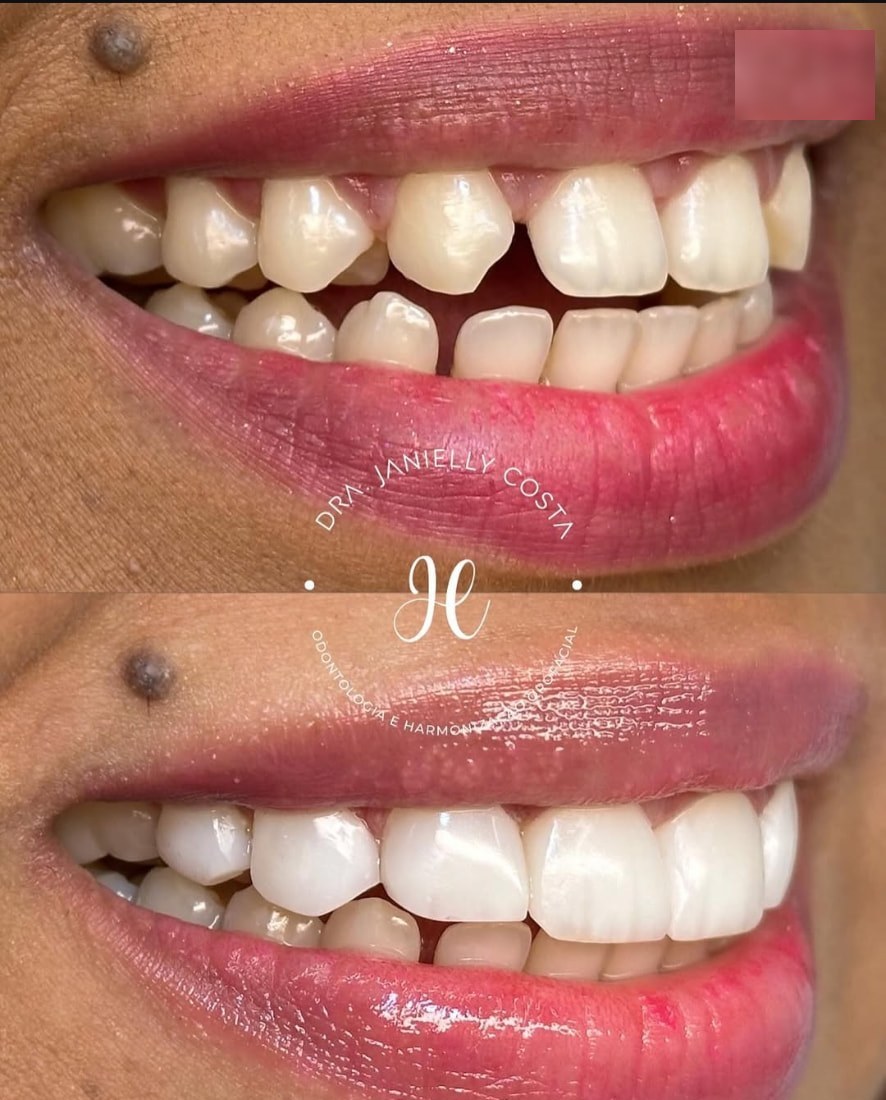 Antes e depois de facetas — caso complexo finalizado