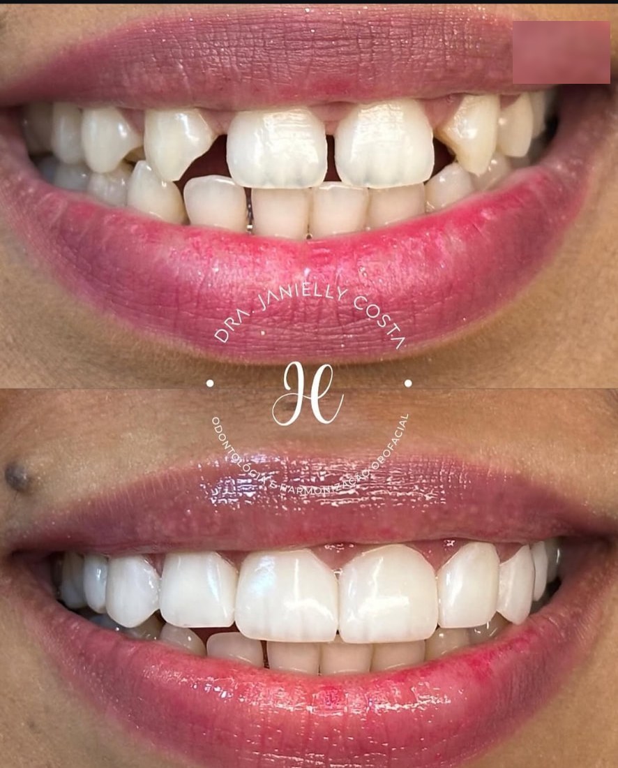 Antes e depois de reabilitação estética do sorriso