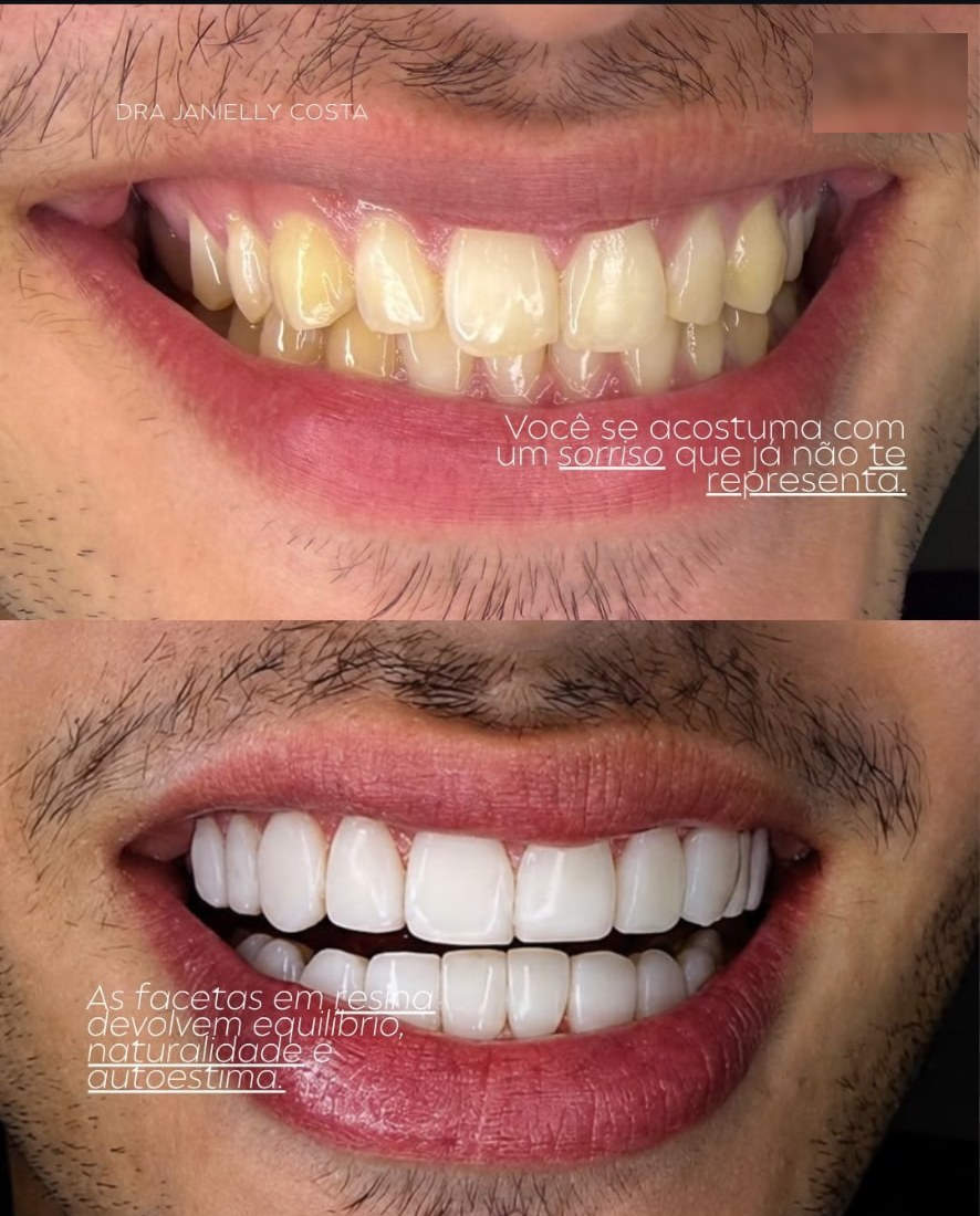 Antes e depois de facetas em resina masculinas