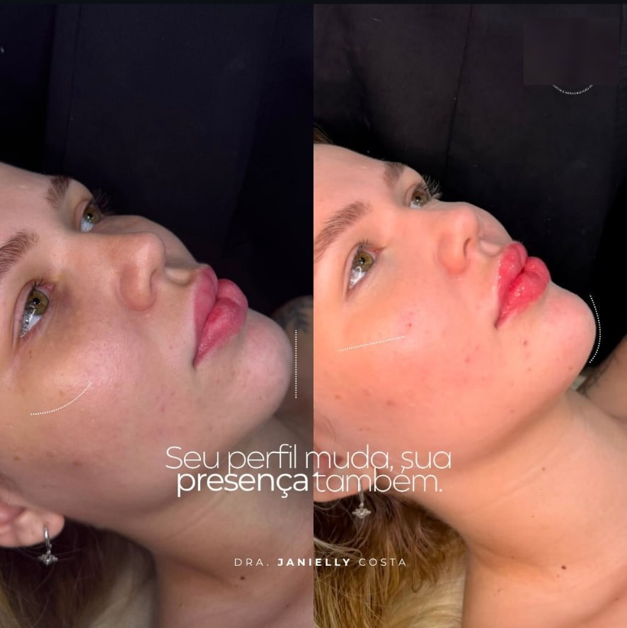 Resultado de harmonização facial realizada pela Dra. Janielly Costa